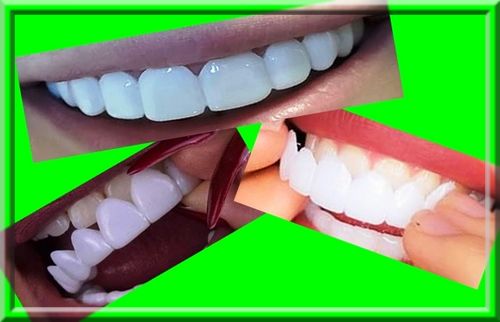 لمینت متحرک لابراتورای یا دندانسازی دندان چیست